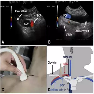 Subclavian Puncture